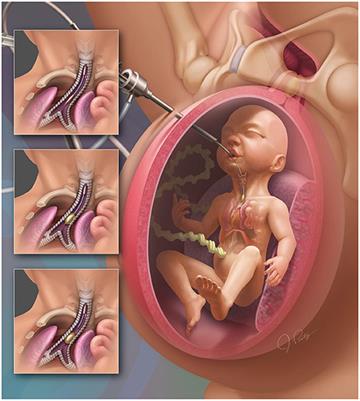 The Cellular and Molecular Effects of Fetoscopic Endoluminal Tracheal Occlusion in Congenital Diaphragmatic Hernia